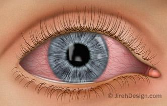Eye allergy illustration