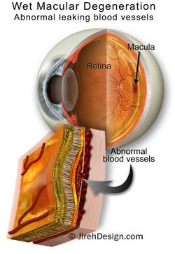 How to avoid macular degeneration by changing lifestyle habits