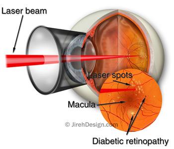 Laser retinal photocoagulation for diabetics