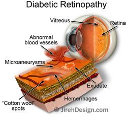 Diabetic retinopathy illustration