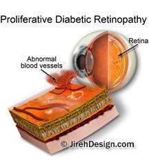 Diabetic retinopathy vision damage