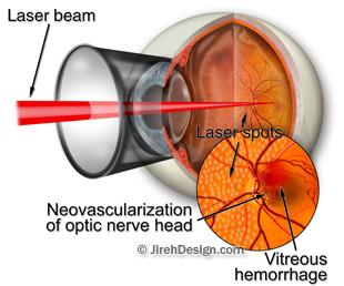 Pan retinal laser photocoagulation laser for diabetes