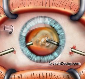 Small incision retina surgery and vitrectomy