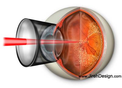 Pascal pattern scan retina laser