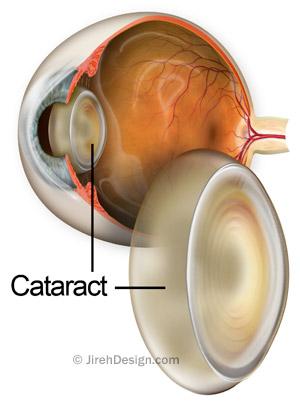 Cataract guide - symptoms, causes, treatment information