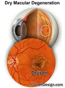 eye health and macular degeneration