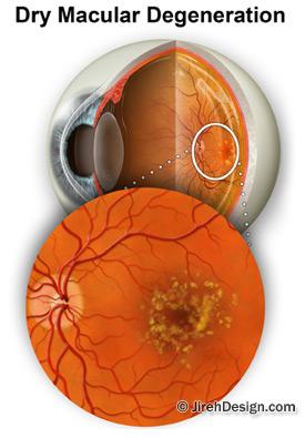 Lutein slows macular degeneration shown in this photo