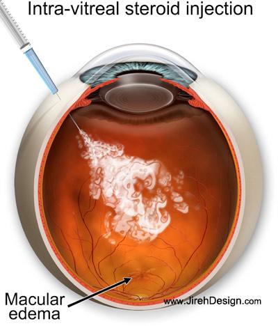 Kenalog eye injection