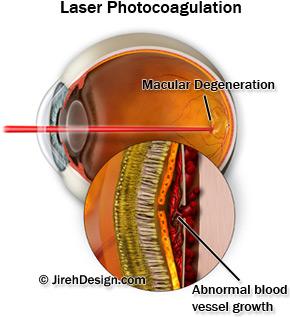 Laser eye surgery for ocular histoplasmosis
