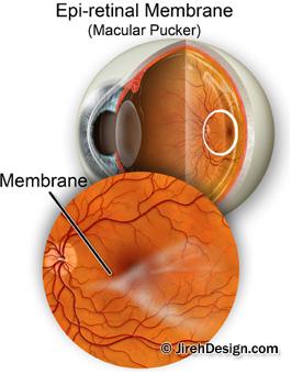 Macular pucker epiretinal membrane can be treated with retinal pucker surgery