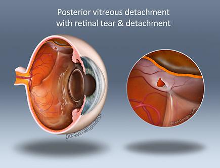 Retinal tear and detachment