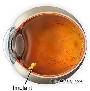 Retisert implant for macular swelling