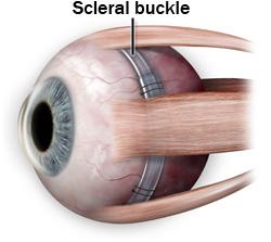 Scleral buckle for retinal detachment