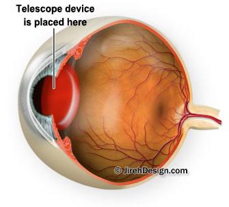 Telescopic eye implant