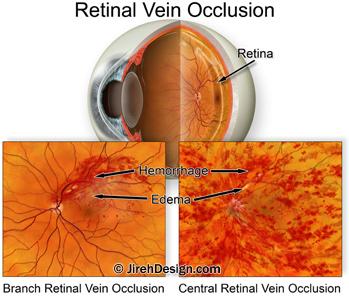 Macular edema in branch retinal vein occlusion BRVO