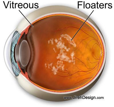 Do Eye Floaters Go Away?