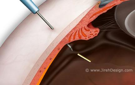 Iluvien vitreous implant for diabetic macular edema