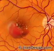 Macular hemorrhage in wet macular degeneration may be helped with stem cell treatment