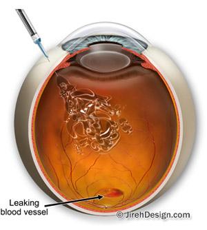 Avastin eye injection for macular degeneration, diabetic retinopathy and retinal vein occlusion