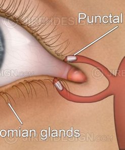 Punctal plugs implants for dry eye syndrome