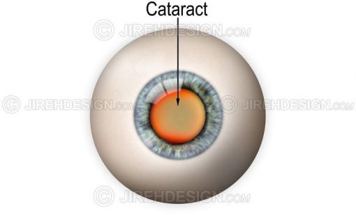 Cataract illustration with eyeball