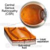 Central serous chorioretinopathy – CSR