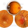 Diabetic retinopathy with NVD
