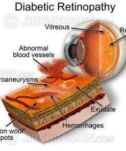 Diabetic retinopathy graphic depicting neovascularization