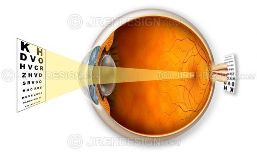 Hyperopic eye and a graphic describing how it affects vision