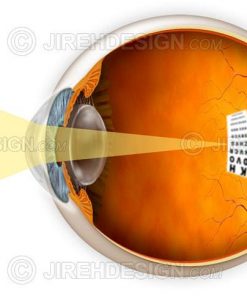 Myopic eye and a graphic describing how it affects vision