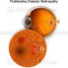 Proliferative diabetic retinopathy – PDR