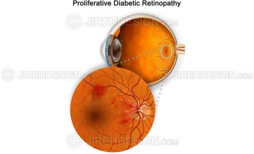 Proliferative diabetic retinopathy – PDR