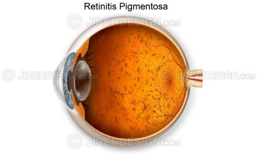 Retinitis pigmentosa #co0035