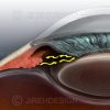 Illustration of closed angle glaucoma co0048