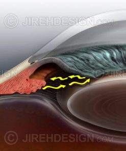 Illustration of closed angle glaucoma co0048