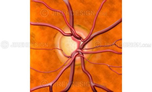 Cupped optic nerve head