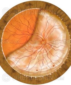Total retinal detachment