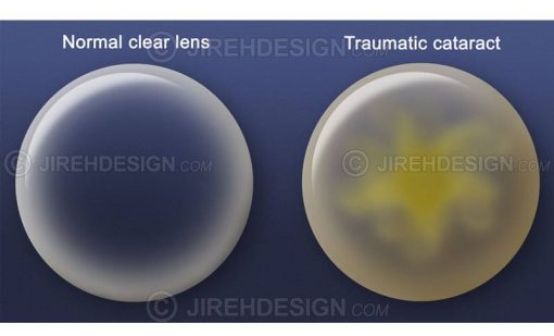 Cataract lens with normal lens