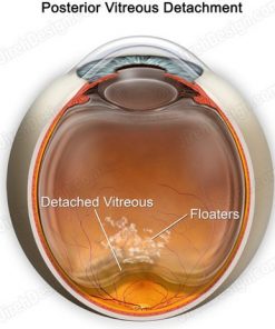 Posterior vitreous detachment