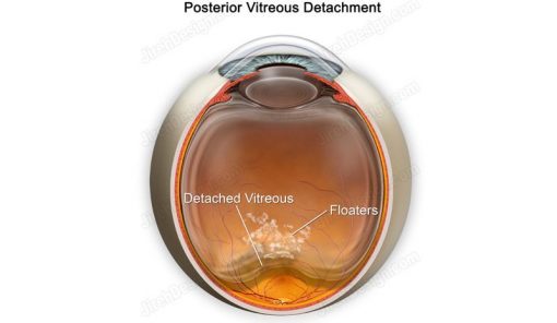 Posterior vitreous detachment #co0071