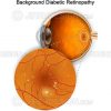 Diabetic retinopathy macula