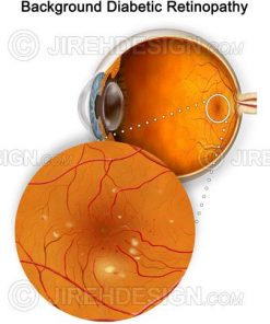 Diabetic retinopathy macula