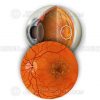 Dry macular degeneration with hard and soft drusen