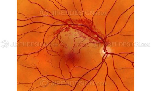 Branch retinal vein occlusion #co0083
