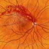 Branch retinal vein occlusion BRVO