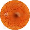 BRAO branch retinal artery occlusion with retina illustration