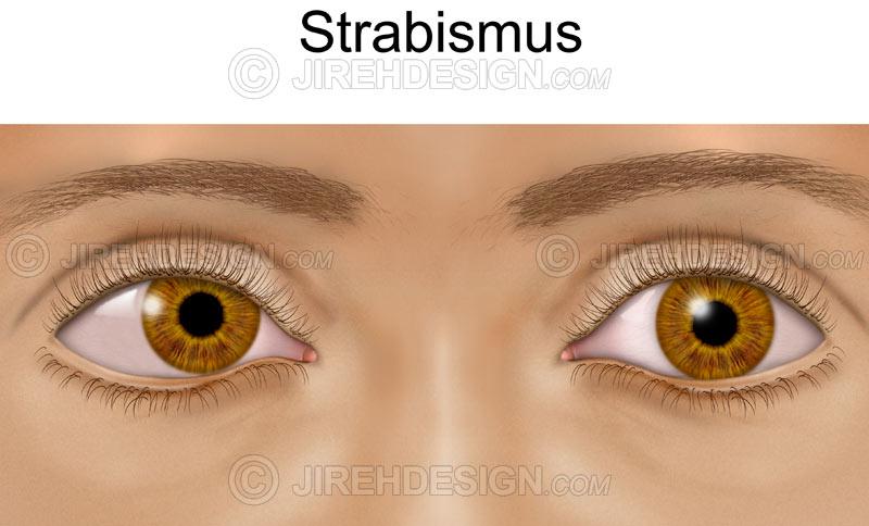 Strabismus - esophoria - #CO0130 - Stock eye images