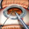 Cataract fragmentation with phaco