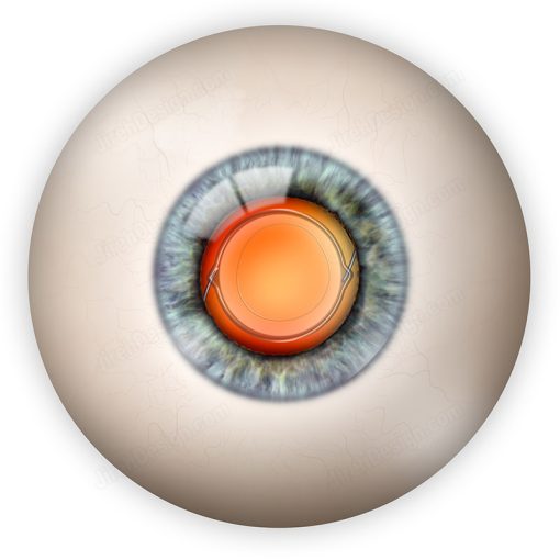 Intraocular lens implant illustration download