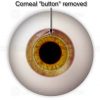 Corneal button removed during pkp